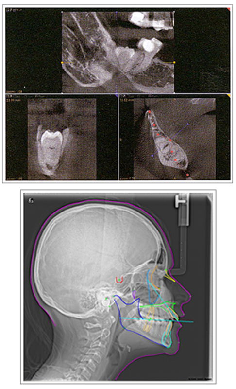 歯科用CT