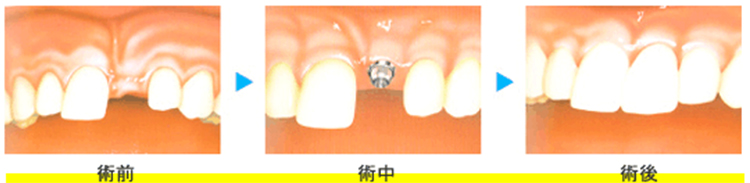 インプラントとは