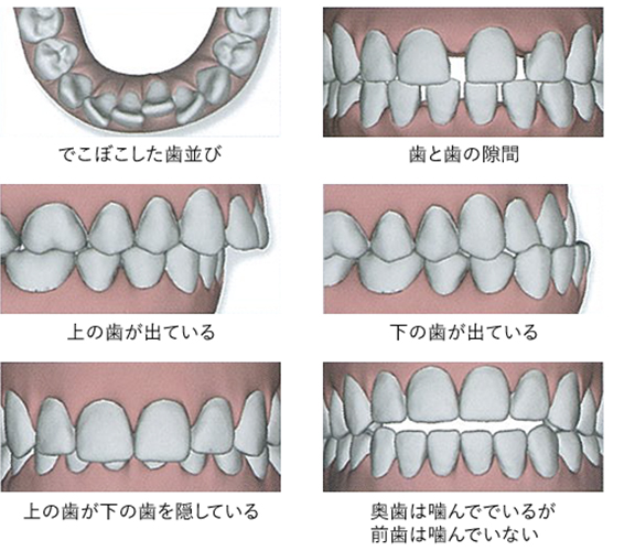 透明マウスピース